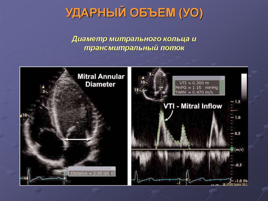 Ударный объем. ЭХОКГ функции. Ударный объем левого желудочка норма. Ударный объем на Эхо. Ударный объем ЭХОКГ.
