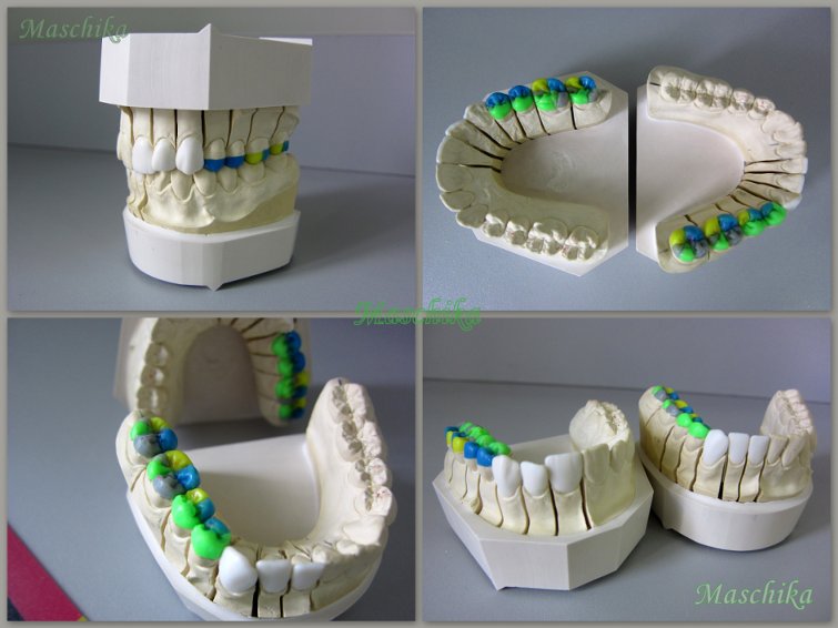 Зубной техник. Портфолио зубного техника. Макет зубов для зуботехника.
