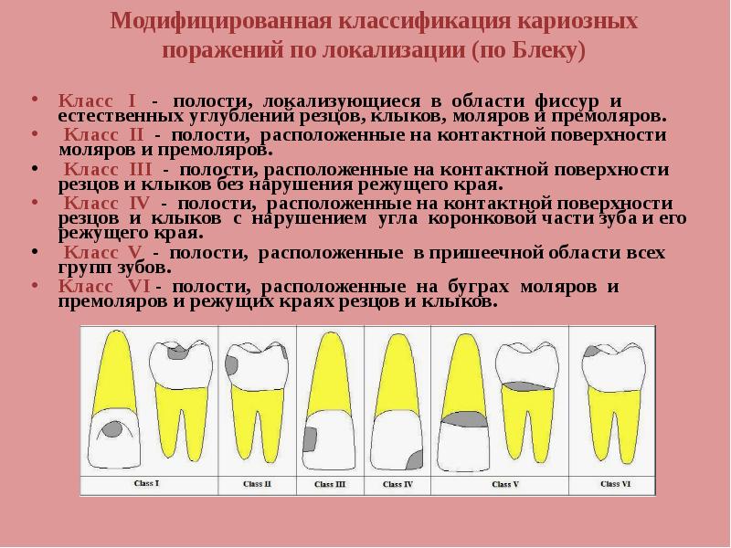 Классы по блэку в стоматологии в картинках